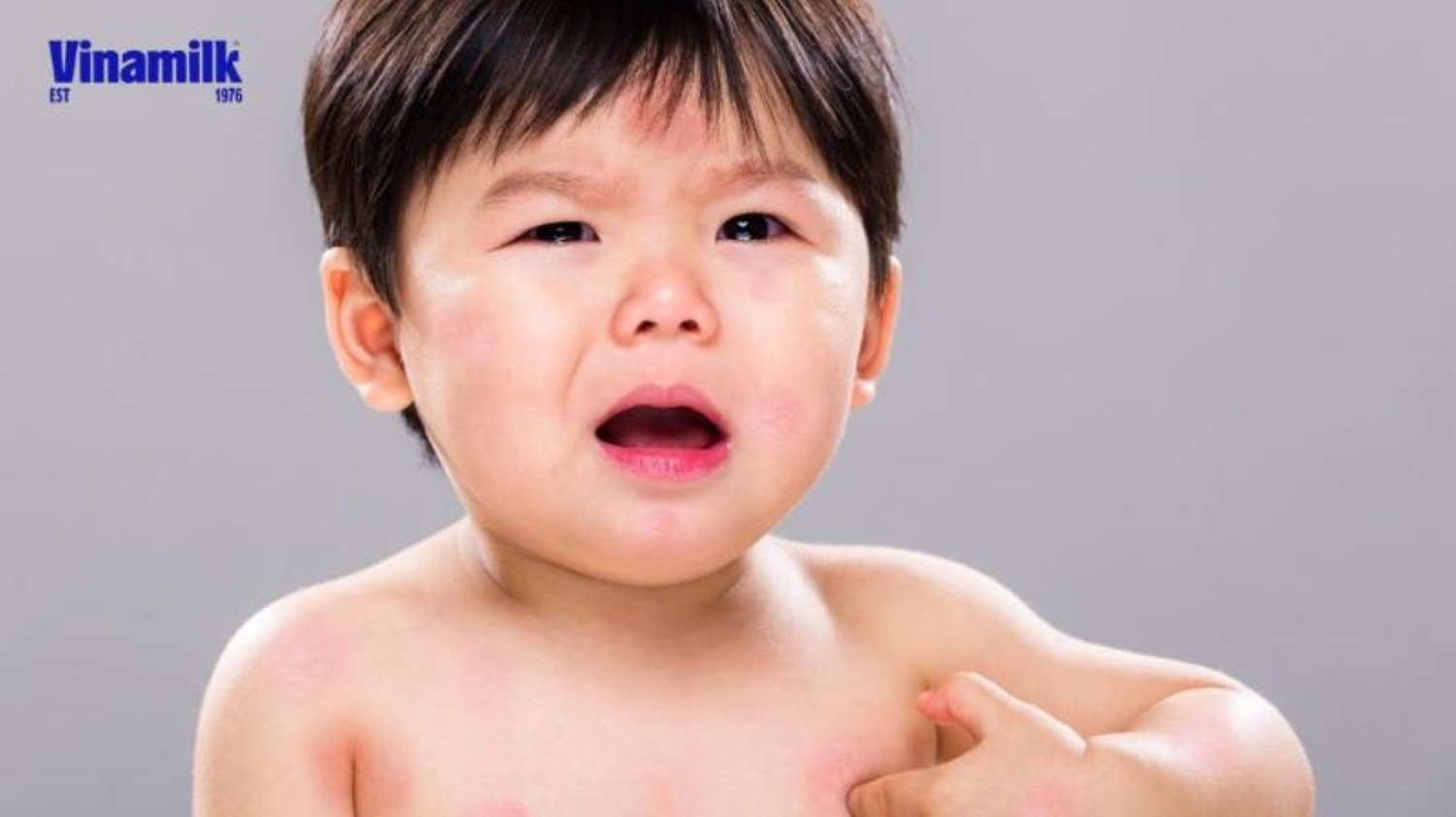 Nguyên nhân dị ứng đạm sữa bò